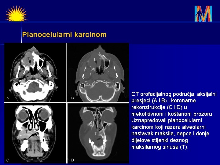 Planocelularni karcinom CT orofacijalnog područja, aksijalni presjeci (A i B) i koronarne rekonstrukcije (C