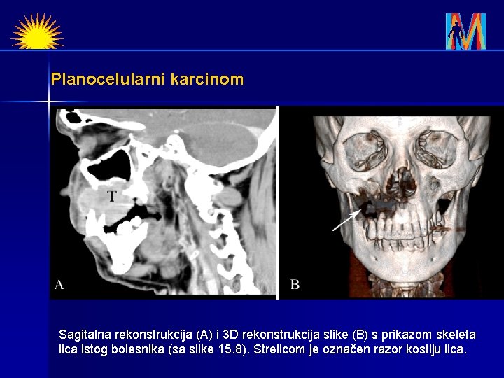 Planocelularni karcinom Sagitalna rekonstrukcija (A) i 3 D rekonstrukcija slike (B) s prikazom skeleta