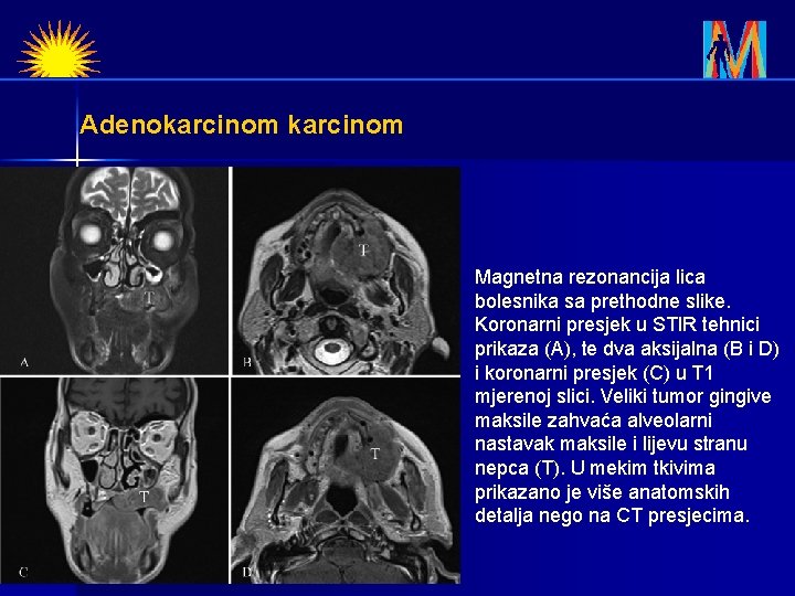 Adenokarcinom Magnetna rezonancija lica bolesnika sa prethodne slike. Koronarni presjek u STIR tehnici prikaza