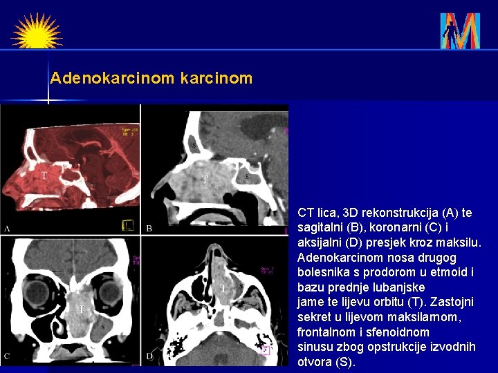 Adenokarcinom CT lica, 3 D rekonstrukcija (A) te sagitalni (B), koronarni (C) i aksijalni