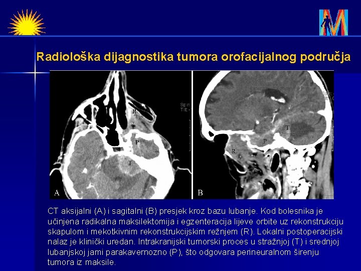 Radiološka dijagnostika tumora orofacijalnog područja CT aksijalni (A) i sagitalni (B) presjek kroz bazu