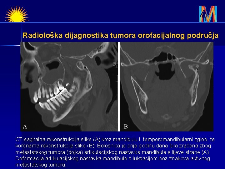 Radiološka dijagnostika tumora orofacijalnog područja CT sagitalna rekonstrukcija slike (A) kroz mandibulu i temporomandibularni