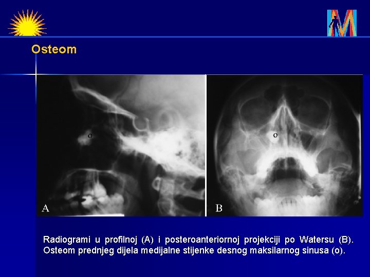 Osteom Radiogrami u profilnoj (A) i posteroanteriornoj projekciji po Watersu (B). Osteom prednjeg dijela