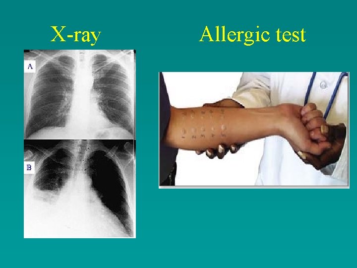 X-ray Allergic test 