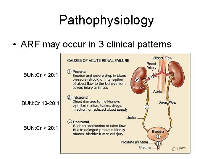 Pathophysiology • ARF may occur in 3 clinical patterns BUN: Cr > 20: 1