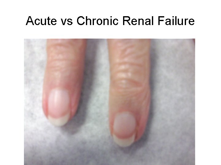 Acute vs Chronic Renal Failure 