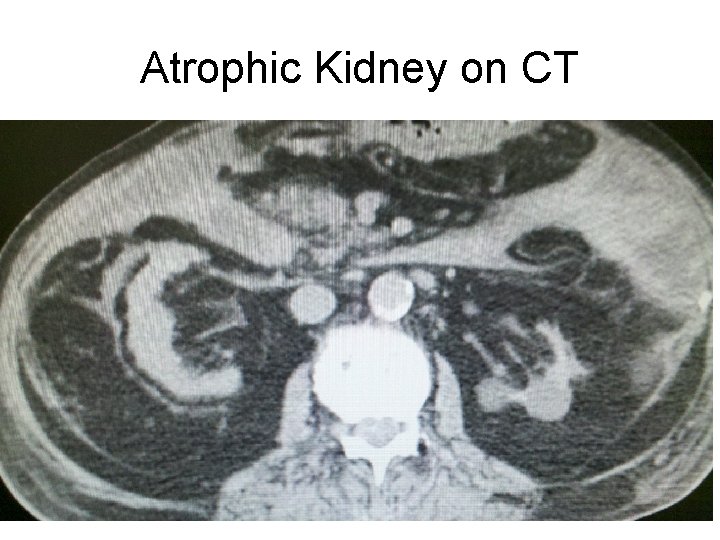 Atrophic Kidney on CT 