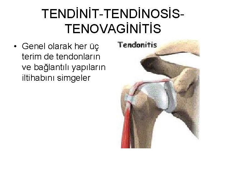 TENDİNİT TENDİNOSİS TENOVAGİNİTİS • Genel olarak her üç terim de tendonların ve bağlantılı yapıların