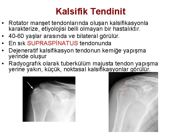 Kalsifik Tendinit • Rotator manşet tendonlarında oluşan kalsifikasyonla karakterize, etiyolojisi belli olmayan bir hastalıktır.