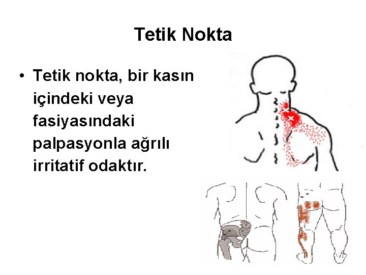 Tetik Nokta • Tetik nokta, bir kasın içindeki veya fasiyasındaki palpasyonla ağrılı irritatif odaktır.