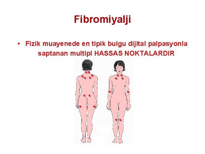 Fibromiyalji • Fizik muayenede en tipik bulgu dijital palpasyonla saptanan multipl HASSAS NOKTALARDIR 