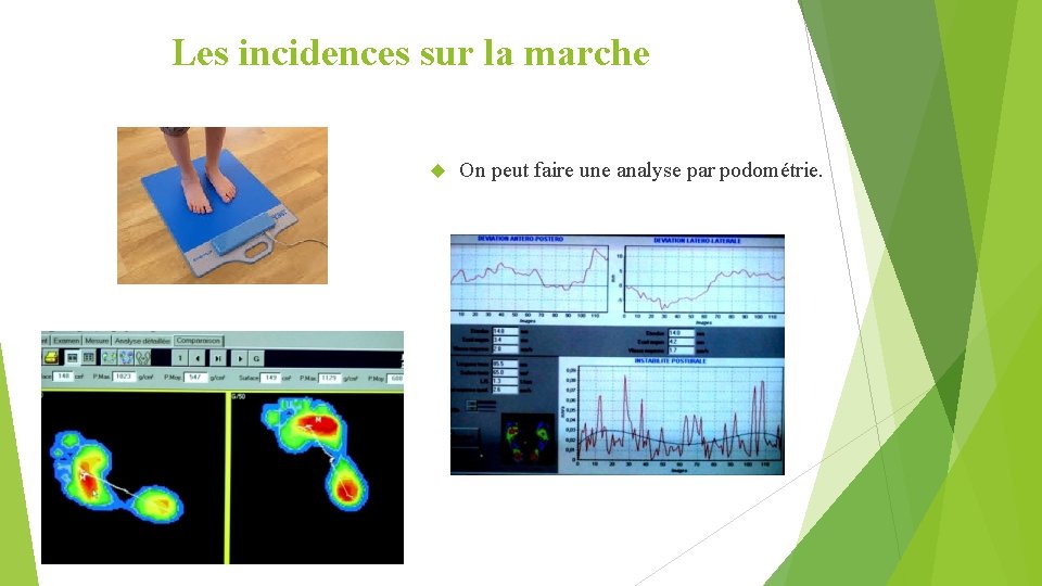 Les incidences sur la marche On peut faire une analyse par podométrie. 