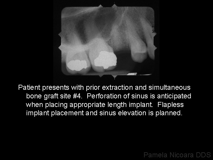 Patient presents with prior extraction and simultaneous bone graft site #4. Perforation of sinus