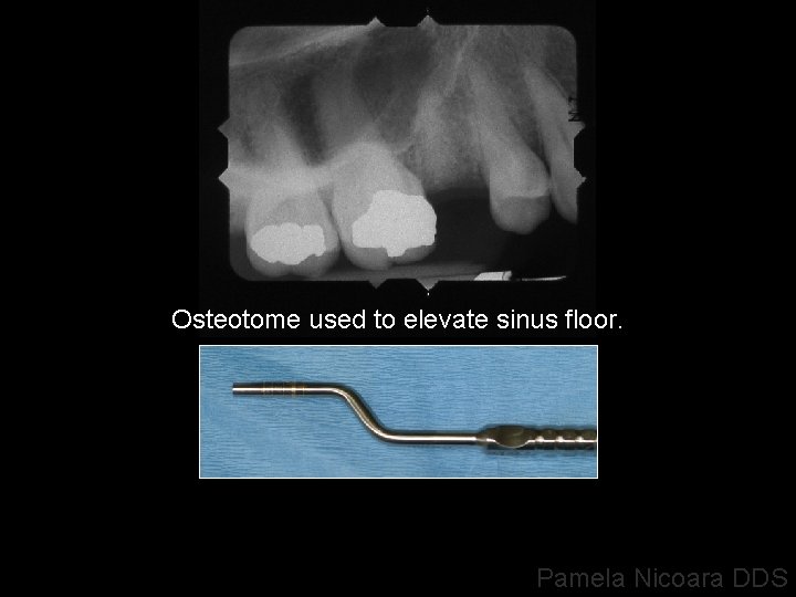 Osteotome used to elevate sinus floor. Pamela Nicoara DDS 