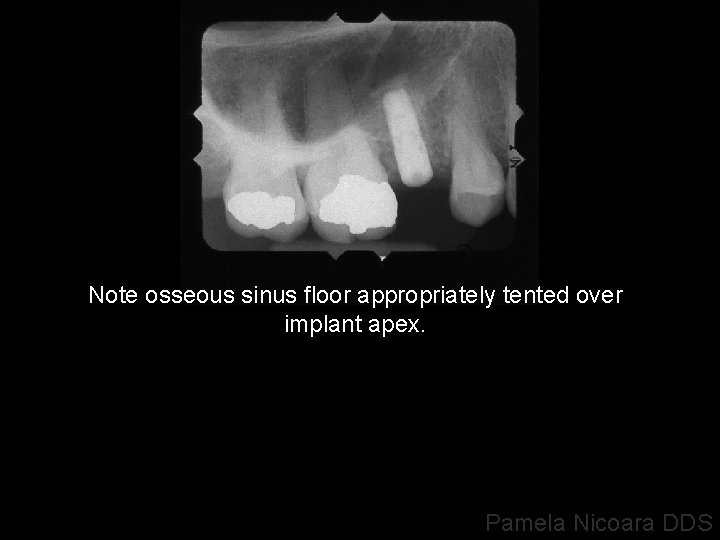 Note osseous sinus floor appropriately tented over implant apex. Pamela Nicoara DDS 