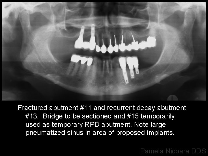 Fractured abutment #11 and recurrent decay abutment #13. Bridge to be sectioned and #15