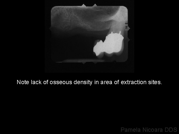 Note lack of osseous density in area of extraction sites. Pamela Nicoara DDS 