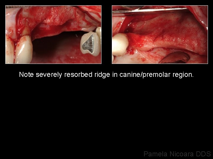 Note severely resorbed ridge in canine/premolar region. Pamela Nicoara DDS 