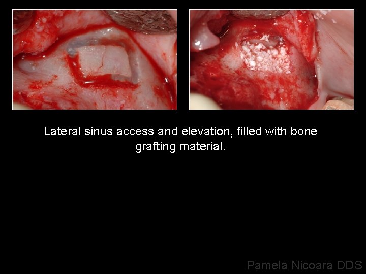 Lateral sinus access and elevation, filled with bone grafting material. Pamela Nicoara DDS 