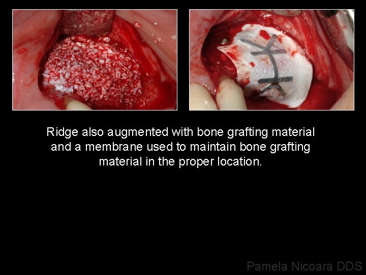 Ridge also augmented with bone grafting material and a membrane used to maintain bone