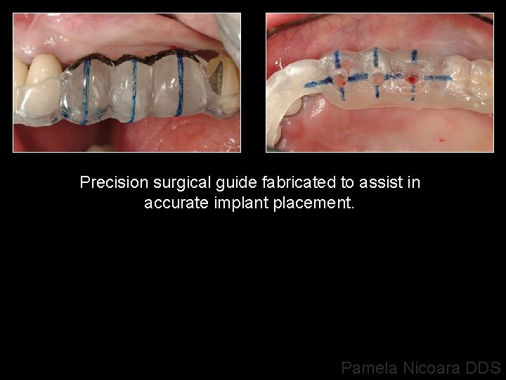 Precision surgical guide fabricated to assist in accurate implant placement. Pamela Nicoara DDS 