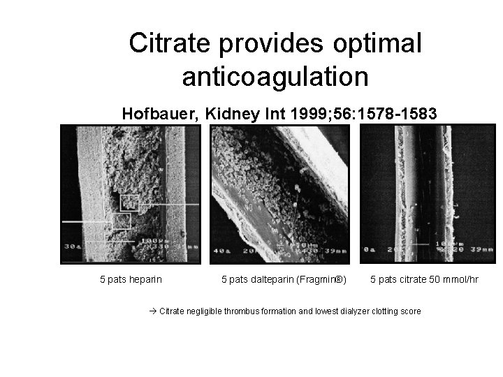 Citrate provides optimal anticoagulation Hofbauer, Kidney Int 1999; 56: 1578 -1583 5 pats heparin