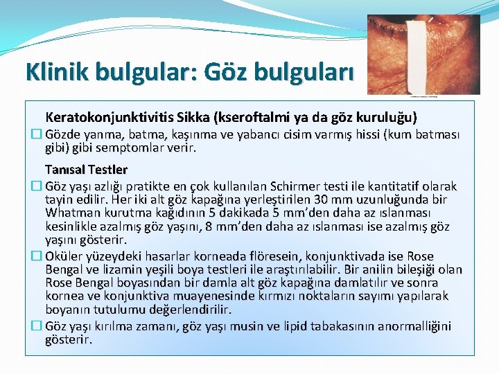 Klinik bulgular: Göz bulguları Keratokonjunktivitis Sikka (kseroftalmi ya da göz kuruluğu) � Gözde yanma,