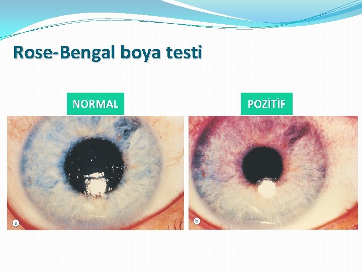 Rose-Bengal boya testi NORMAL POZİTİF 