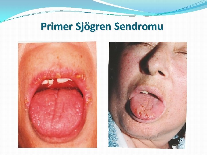 Primer Sjögren Sendromu 