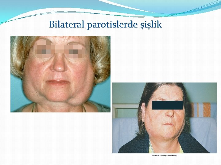 Bilateral parotislerde şişlik 