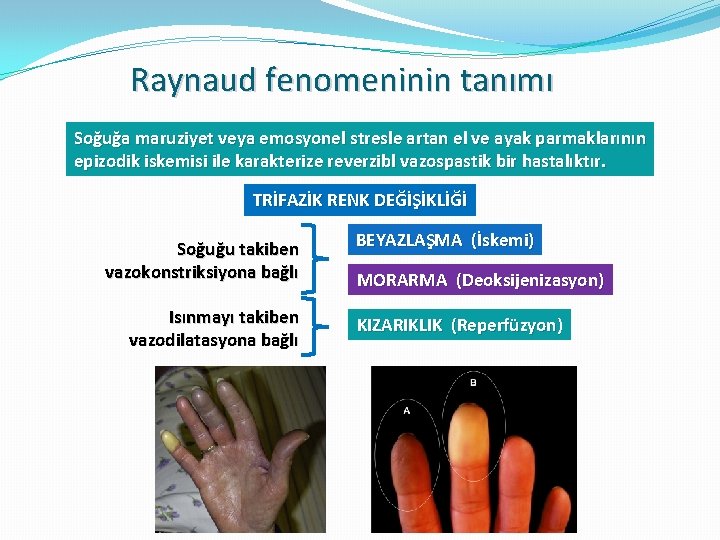 Raynaud fenomeninin tanımı Soğuğa maruziyet veya emosyonel stresle artan el ve ayak parmaklarının epizodik