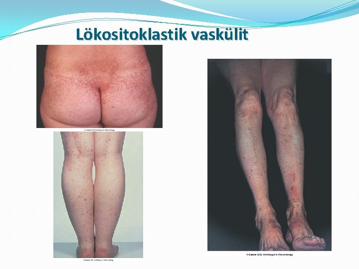 Lökositoklastik vaskülit 