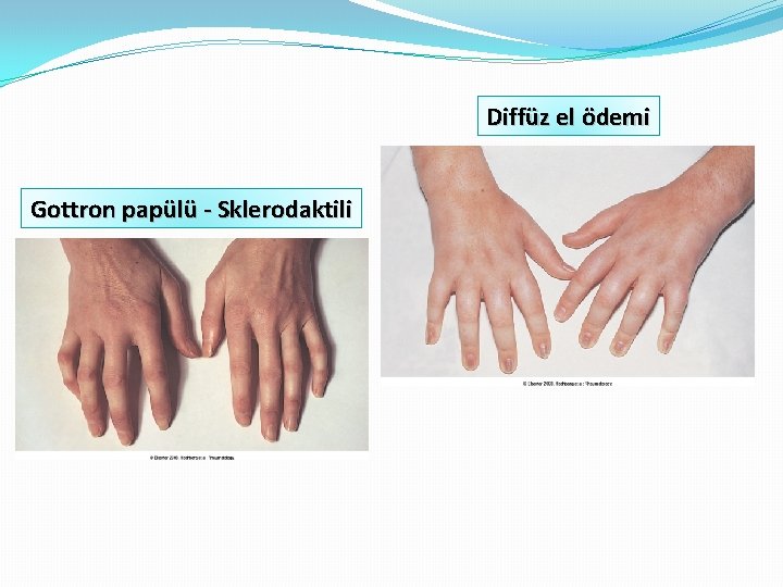 Diffüz el ödemi Gottron papülü - Sklerodaktili 