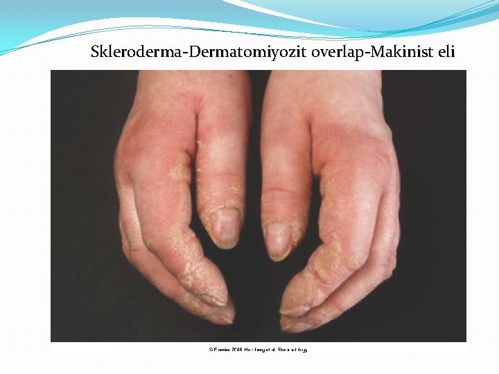 Skleroderma-Dermatomiyozit overlap-Makinist eli 