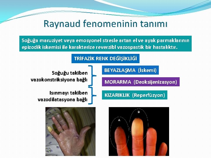 Raynaud fenomeninin tanımı Soğuğa maruziyet veya emosyonel stresle artan el ve ayak parmaklarının epizodik