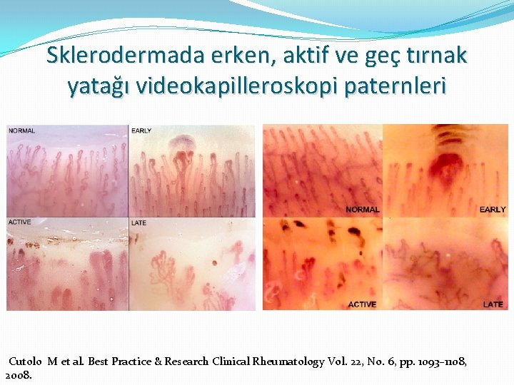 Sklerodermada erken, aktif ve geç tırnak yatağı videokapilleroskopi paternleri Cutolo M et al. Best