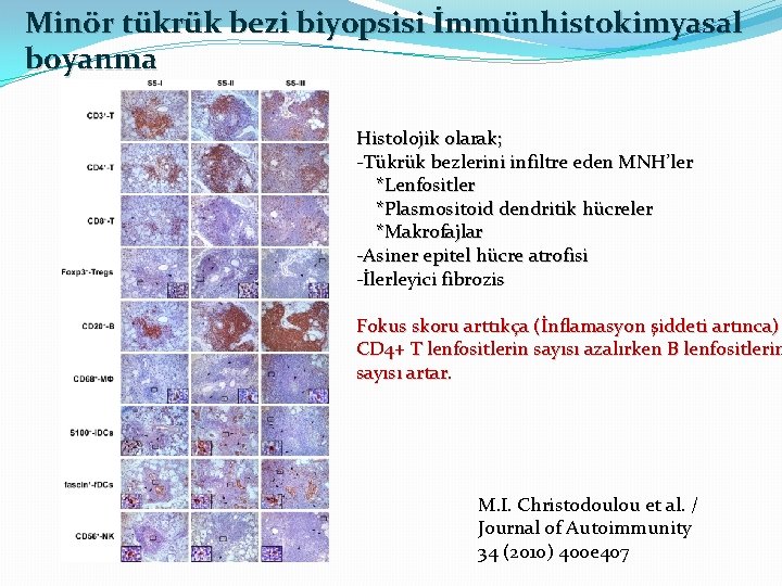 Minör tükrük bezi biyopsisi İmmünhistokimyasal boyanma Histolojik olarak; -Tükrük bezlerini infiltre eden MNH’ler *Lenfositler