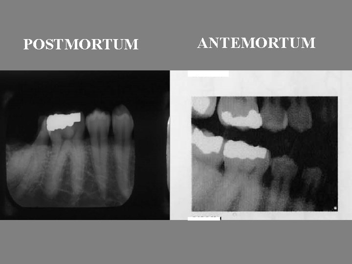 POSTMORTUM ANTEMORTUM 