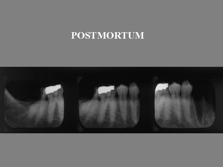 POSTMORTUM 