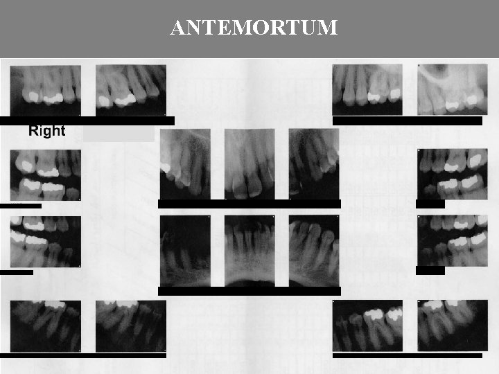 ANTEMORTUM 