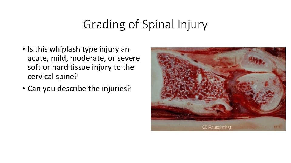 Grading of Spinal Injury • Is this whiplash type injury an acute, mild, moderate,