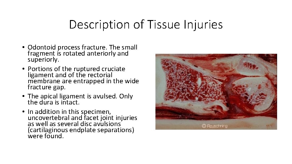 Description of Tissue Injuries • Odontoid process fracture. The small fragment is rotated anteriorly