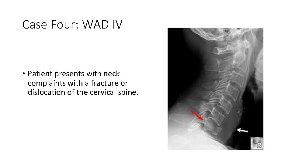 Case Four: WAD IV • Patient presents with neck complaints with a fracture or