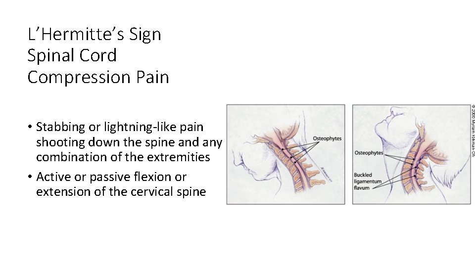 L’Hermitte’s Sign Spinal Cord Compression Pain • Stabbing or lightning‐like pain shooting down the