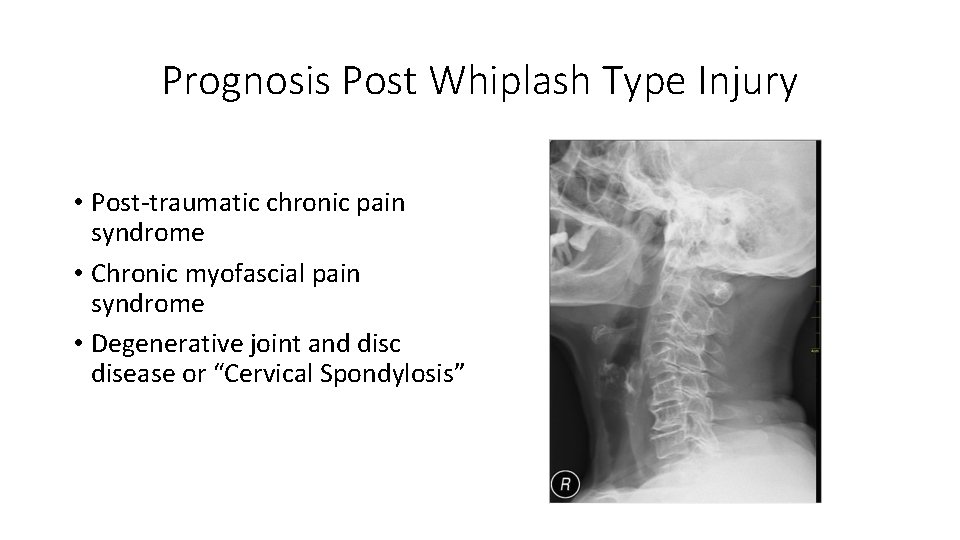 Prognosis Post Whiplash Type Injury • Post‐traumatic chronic pain syndrome • Chronic myofascial pain