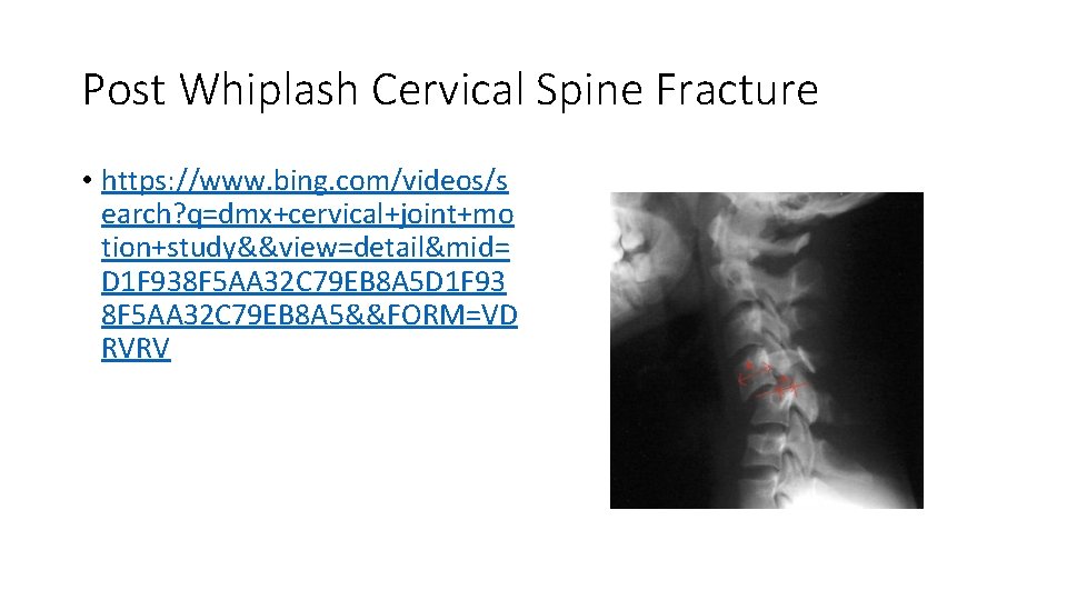 Post Whiplash Cervical Spine Fracture • https: //www. bing. com/videos/s earch? q=dmx+cervical+joint+mo tion+study&&view=detail&mid= D