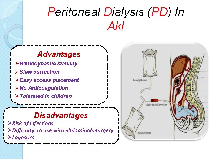 Peritoneal Dialysis (PD) In Ak. I Advantages ØHemodynamic stability ØSlow correction ØEasy access placement