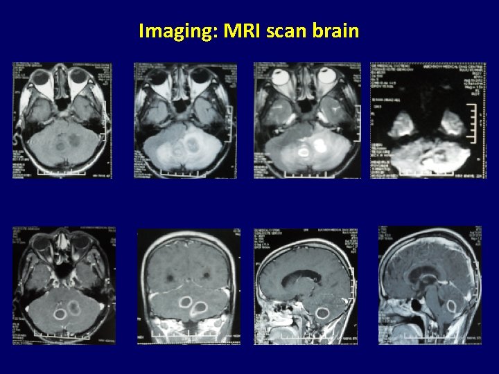 Imaging: MRI scan brain 