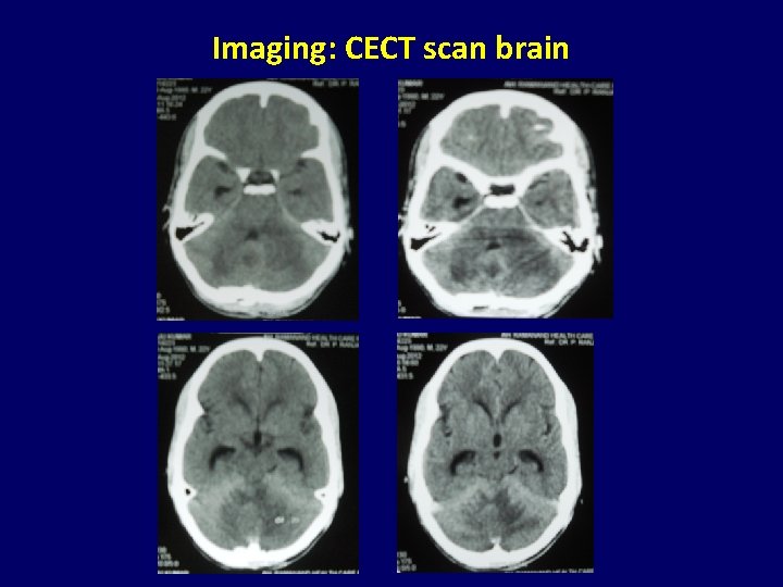 Imaging: CECT scan brain 