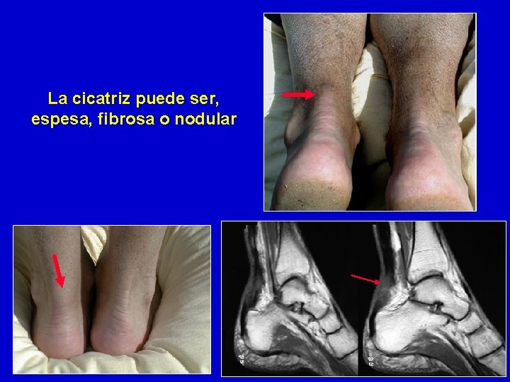 La cicatriz puede ser, espesa, fibrosa o nodular 